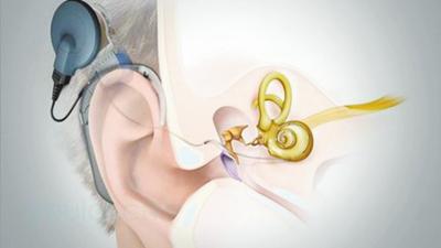电子耳蜗的冬季保养常识