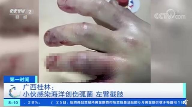 男子手指被海鱼刺扎伤感染手臂截肢保命 处理海鲜注意事项